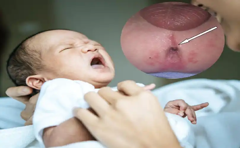 Anorectal Malformation (ARM) in children