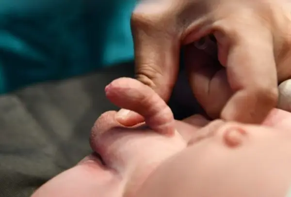 Hypospadias