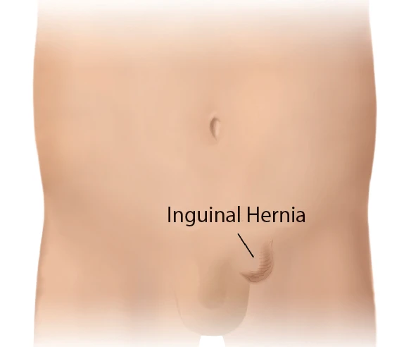 Inguinal Hernia in Children