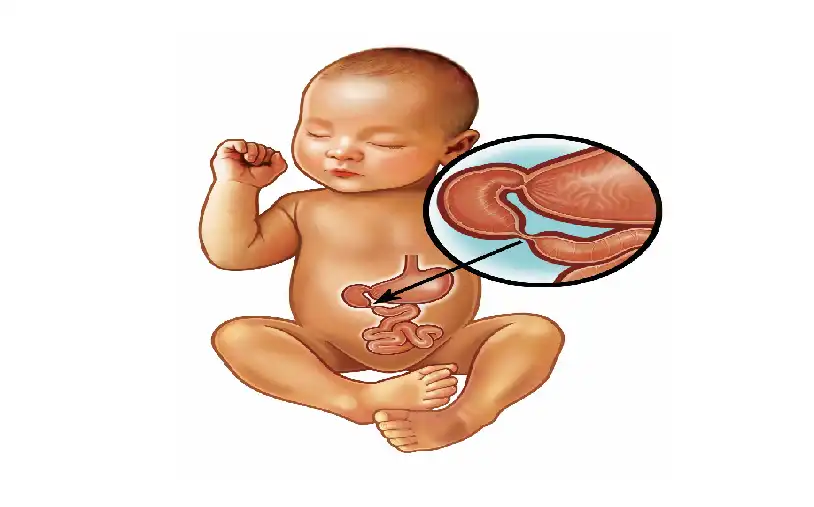 Intestinal Atresia in Children