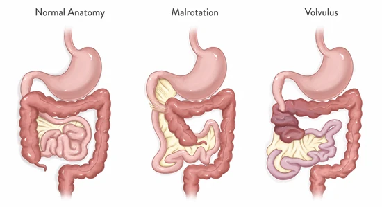 Intestinal Malrotation in Children