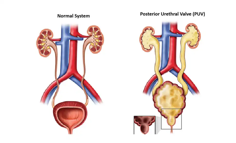 Posterior Urethral Valve (PUV) in Children