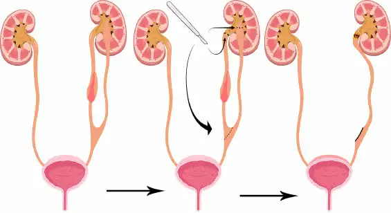 Renal Duplication in Children