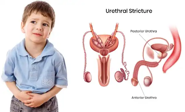 Urethral Stricture in Children