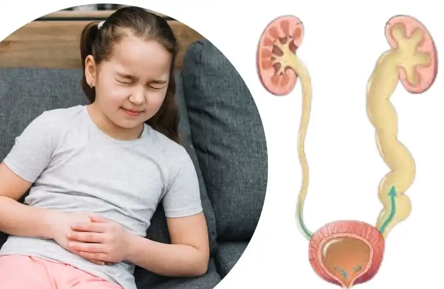 Vesicoureteral Reflux (VUR) in Children