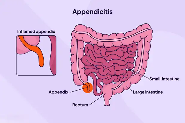 Appendicitis in Children