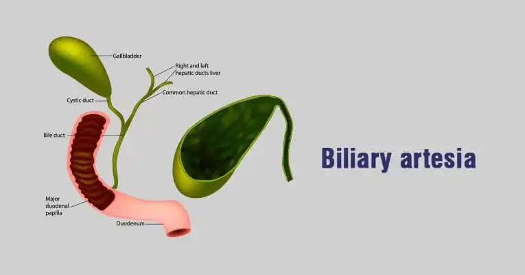Biliary Atresia in Children