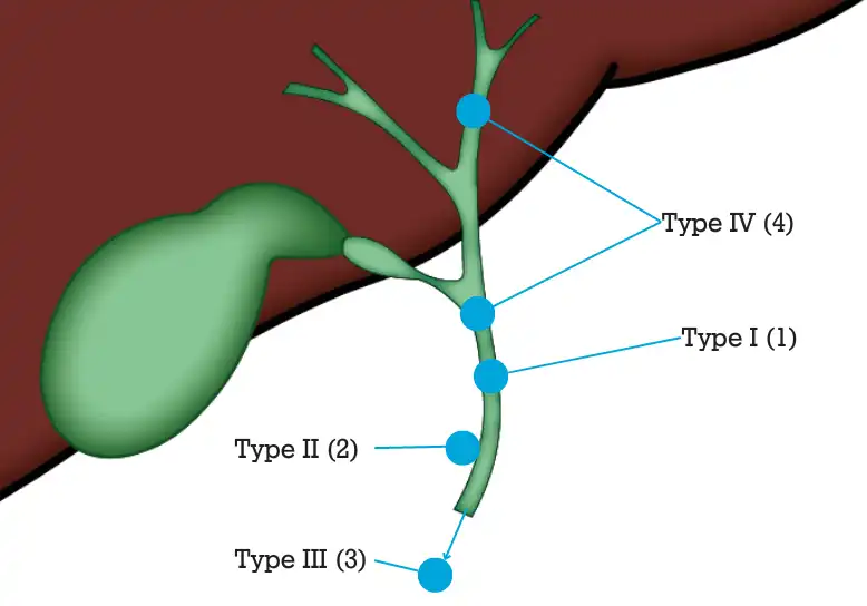 Choledochal Cysts in Children