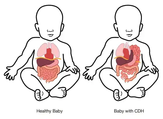 Congenital-Diaphragmatic-Hernia-in-Children