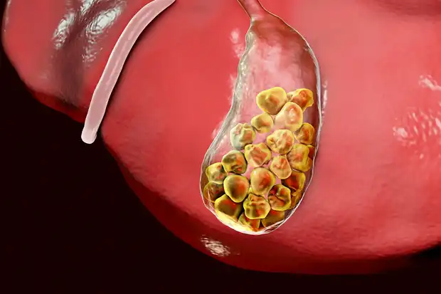 Gallstones (Cholelithiasis) in Children