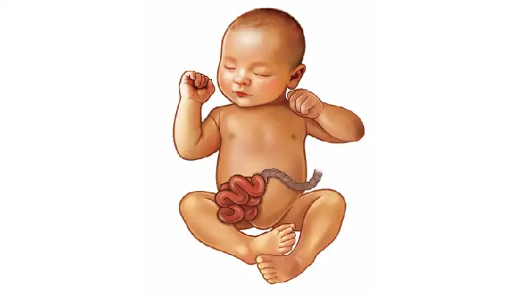 Gastroschisis in Children