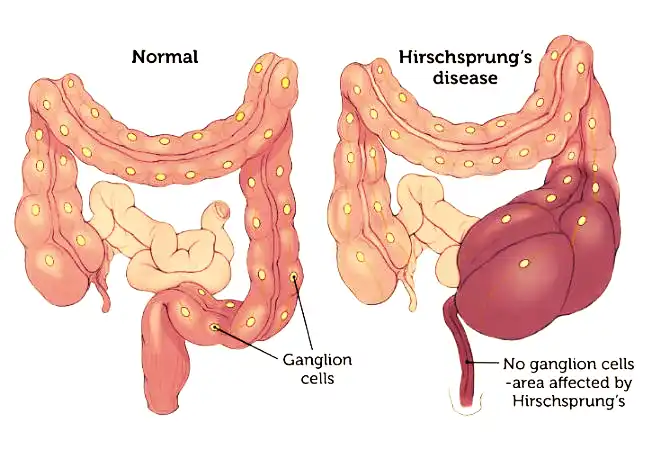 Hirschsprung Disease in Children