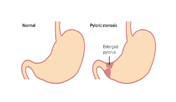 Infantile Hypertrophic Pyloric Stenosis (IHPS)