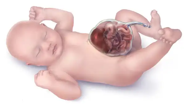 Omphalocoele in Children