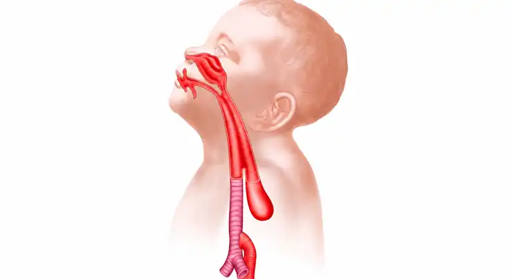 Tracheoesophageal Fistula (TEF) in Children