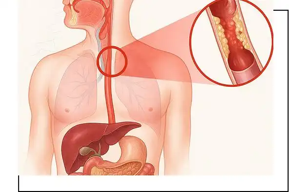 Esophageal Disorders in Children