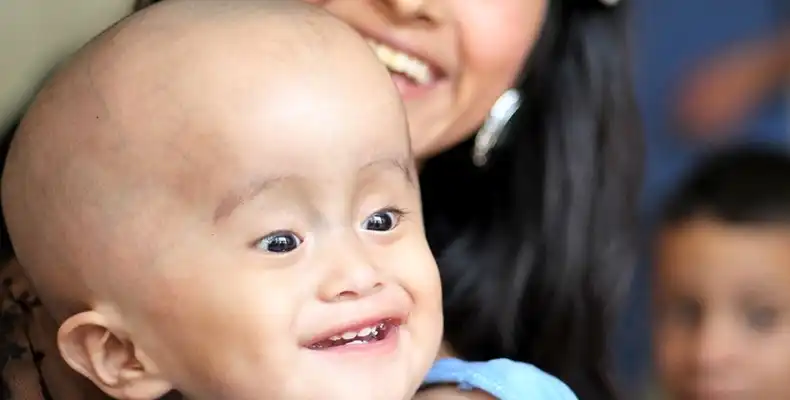 Hydrocephalus in Children