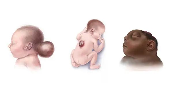 Neural Tube Defects (NTDs) in Children
