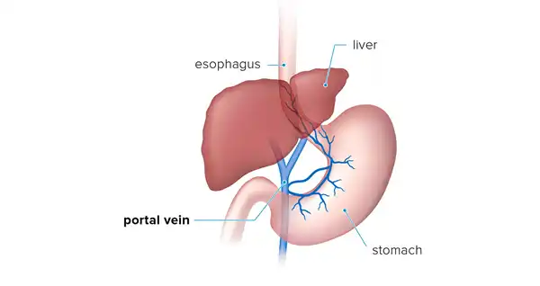 Portal Hypertension in Children