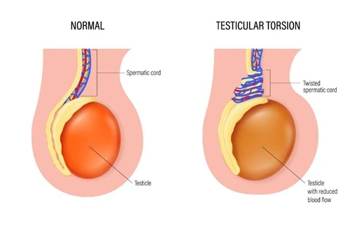 Testicular Torison in Children