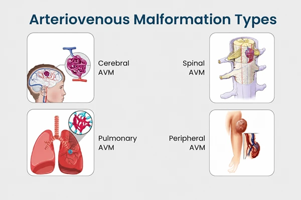 Arteriovenous Malformation (AVM) in Children