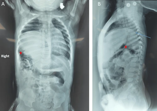 Diaphragm Eventration in Children