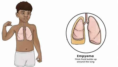 Empyema in Children