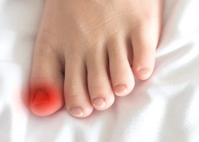 Ingrown Toenail in Children