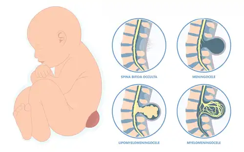 Meningomyelocele (MMC) in Children