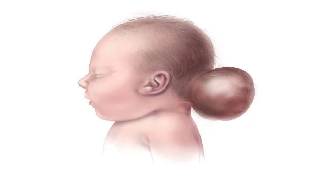 Occipital Encephalocele in Children