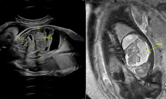 Retroperitoneal Teratoma in Children