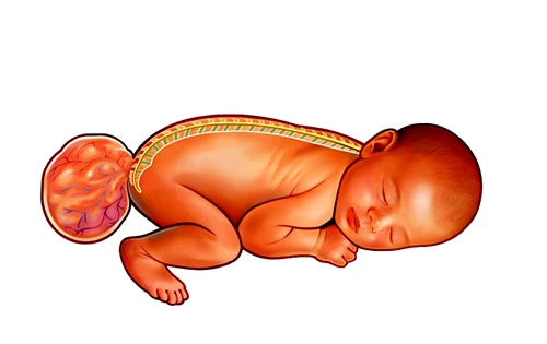 Sacrococcygeal Teratoma (SCT) in Children