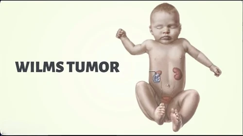 Wilms Tumor in Children