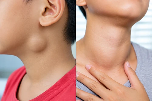 Branchial Cyst and Sinus in Children
