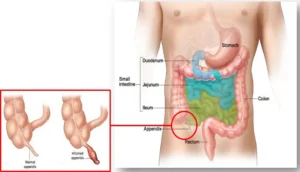 Pediatric Appendectomy (Appendix Removal Surgery)