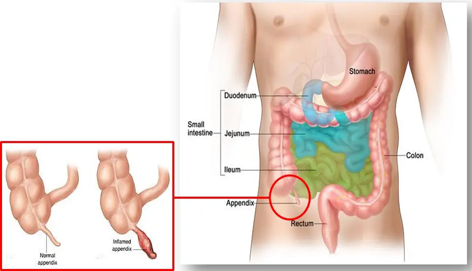 Pediatric Appendectomy (Appendix Removal Surgery)