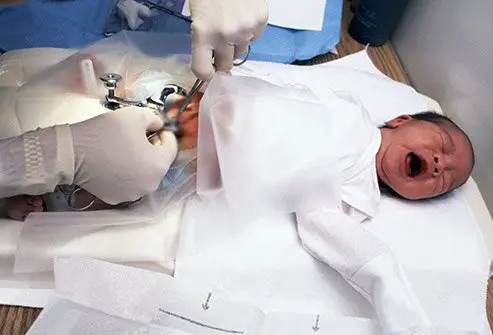 Pediatric Circumcision Surgery