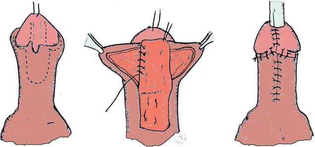 Pediatric Hypospadias Repair Surgery