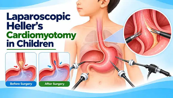 Laparoscopic Heller’s Cardiomyotomy in Children