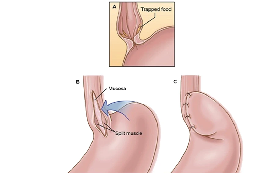 Pediatric Achalasia Cardia Surgery
