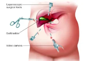 Pediatric Cholecystectomy (Gallbladder Removal Surgery)