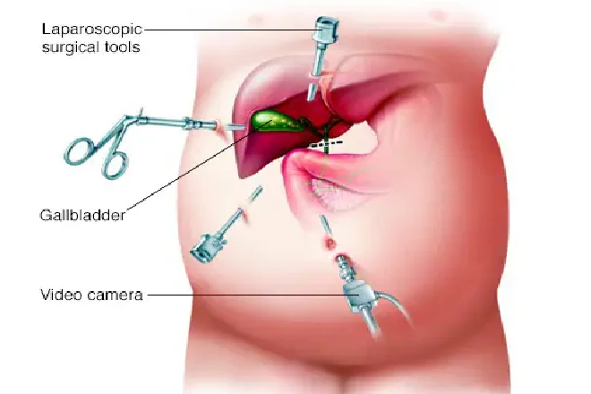 Pediatric Cholecystectomy (Gallbladder Removal Surgery)