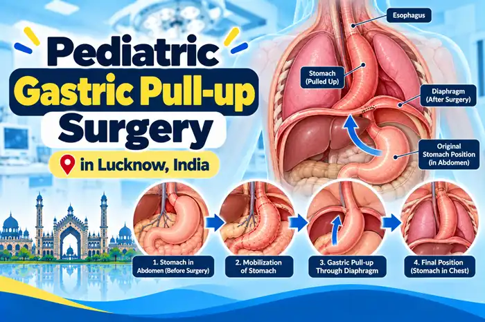 Pediatric Gastric Pull-Up Surgery