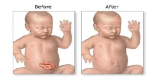 Pediatric Gastroschisis Repair Surgery