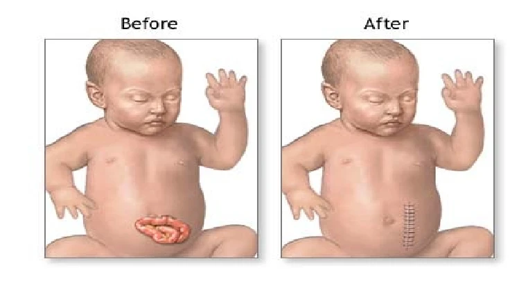 Pediatric Gastroschisis Repair Surgery