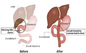 Pediatric Kasai Procedure (Biliary Atresia Surgery)