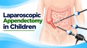Laparoscopic Appendectomy in Children