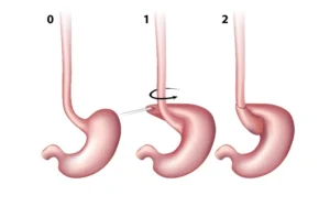 Pediatric Laparoscopic Nissen Fundoplication Surgery