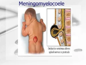 Pediatric Meningomyelocele Surgery