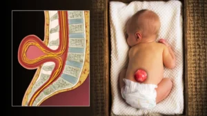 Pediatric Neural Tube Defect Surgery